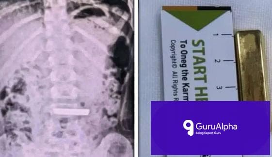 50-Gram Gold Bar Swallowed by 5-Year-Old in China Triggers Emergency Removal