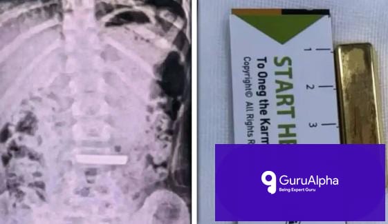 50-Gram Gold Bar Swallowed by 5-Year-Old in China Triggers Emergency Removal