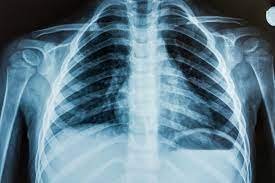 What Is an X-ray?