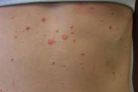 How to Cope With Stubborn Psoriasis Spots