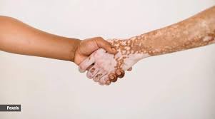 Managing Your Emotional Health With Vitiligo
