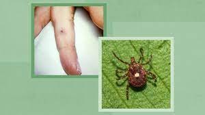 How Ticks Can Make You Sick